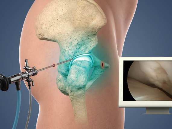 Hip Arthroplasty in Ahmedabad