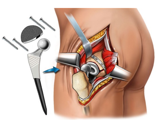 Hip Replacement Surgery in Ahmedabad